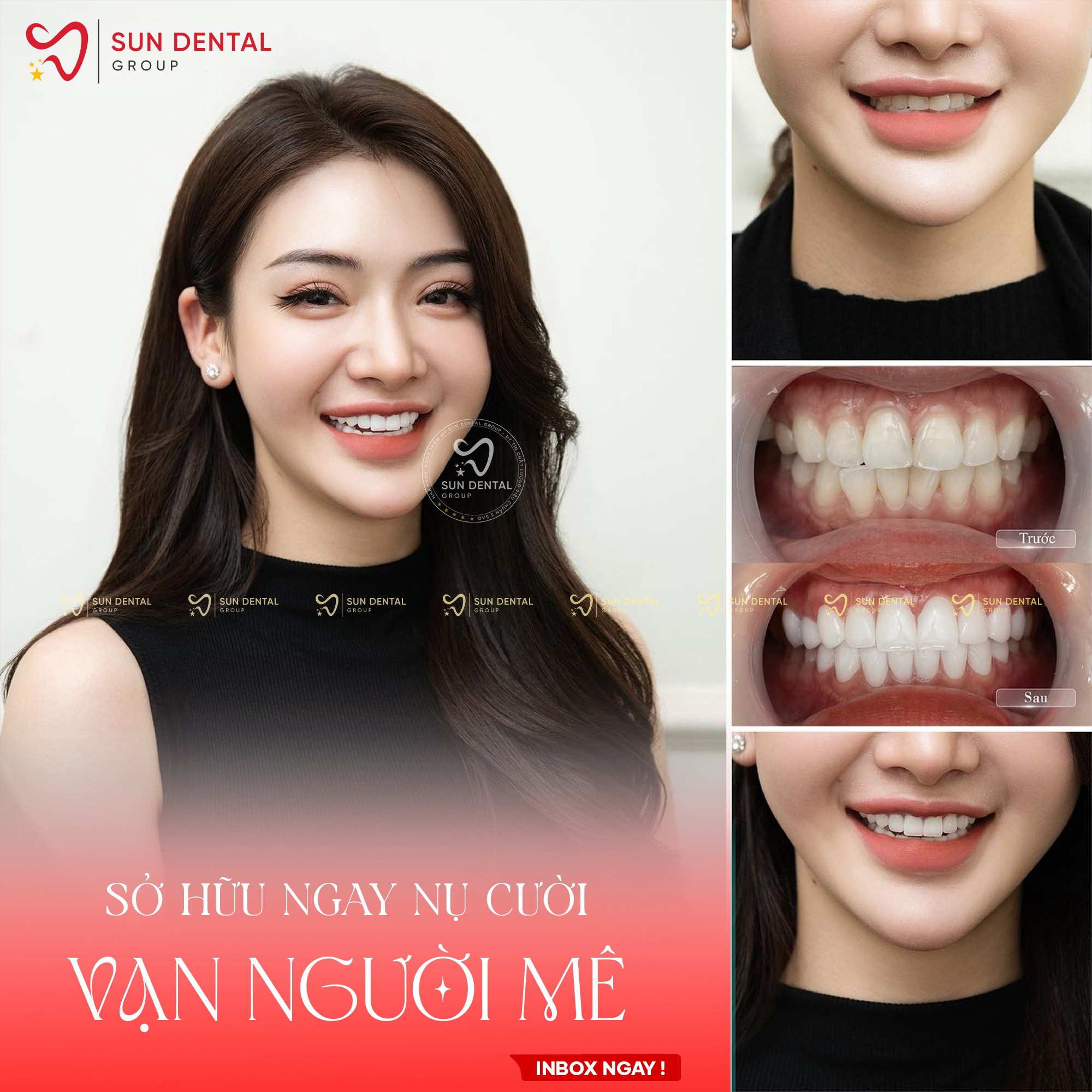 Bọc Sứ Thay Đổi Thẩm Mỹ - Nụ Cười Vạn Người Mê